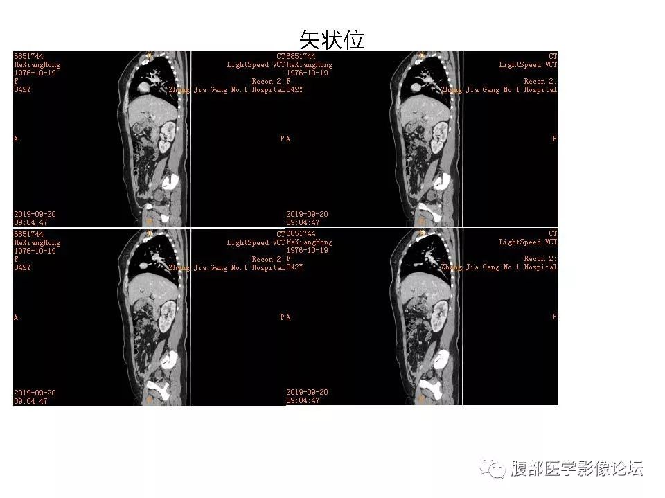 【病例】十二指肠布氏腺错构瘤1例CT影像