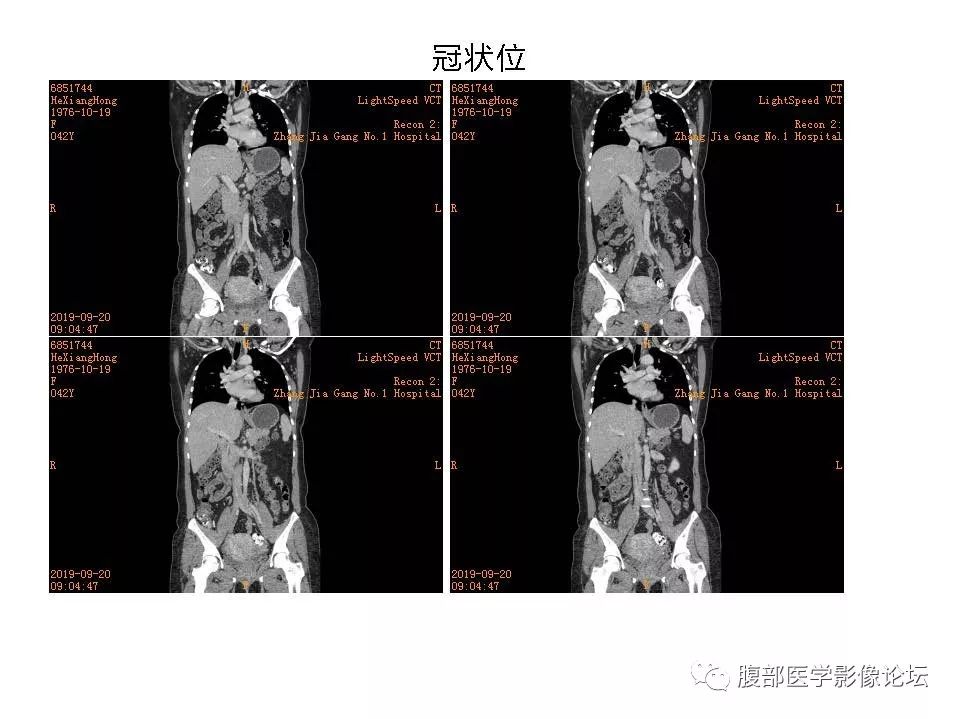【病例】十二指肠布氏腺错构瘤1例CT影像