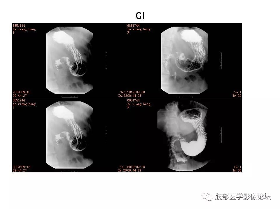 【病例】十二指肠布氏腺错构瘤1例CT影像