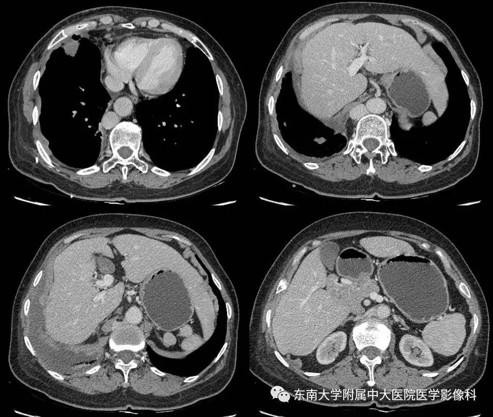 【PPT】多脾综合征的影像