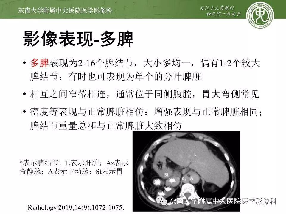 【PPT】多脾综合征的影像