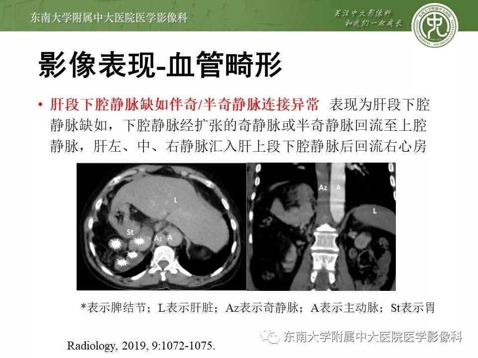 【PPT】多脾综合征的影像