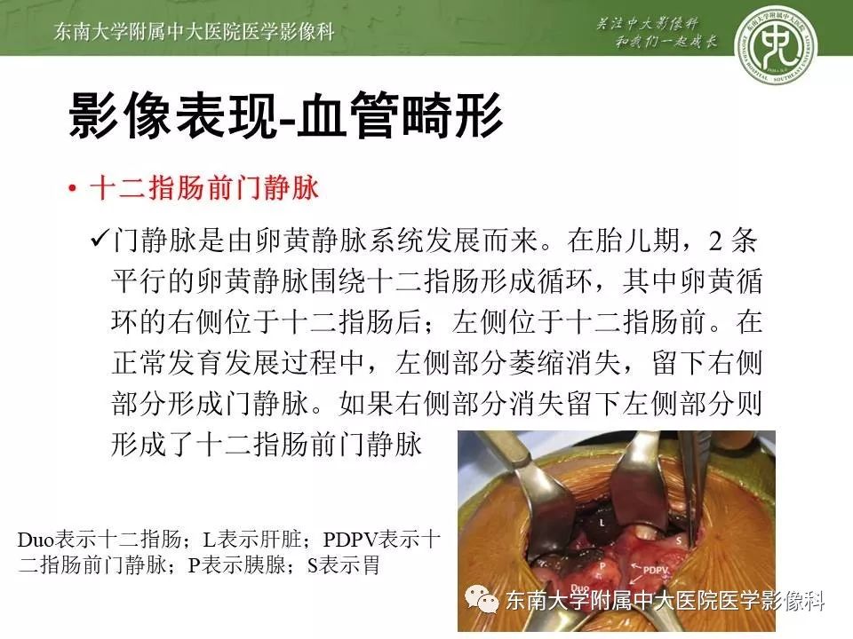 【PPT】多脾综合征的影像