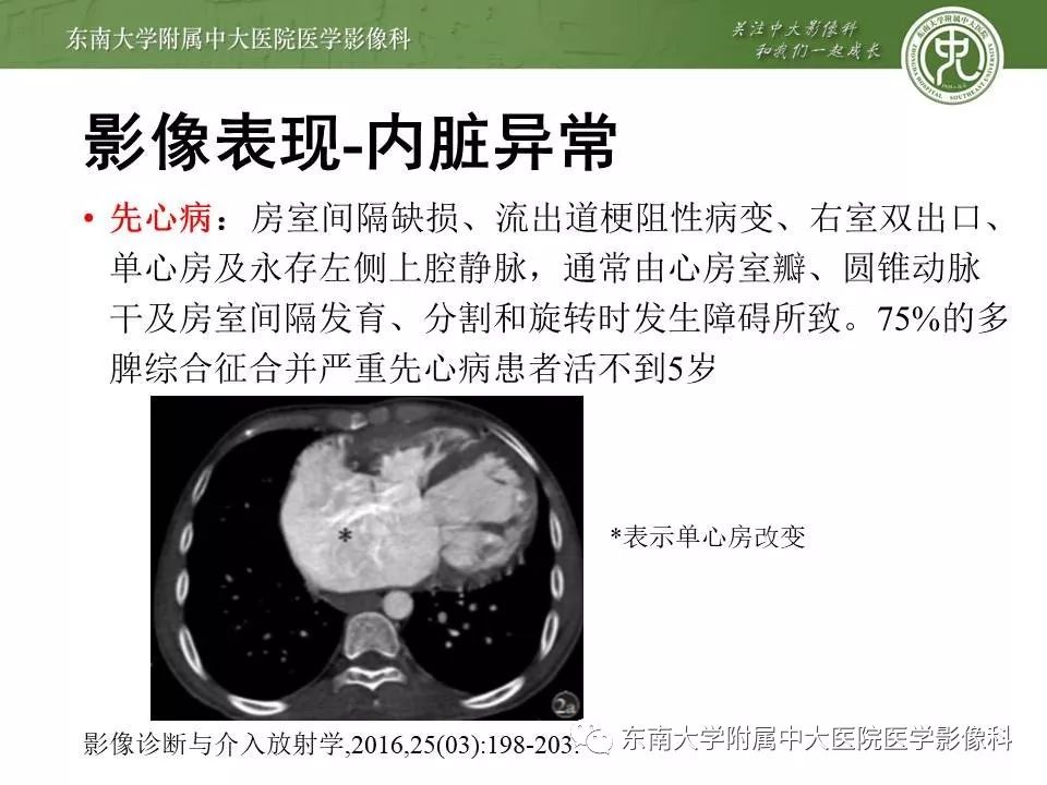【PPT】多脾综合征的影像