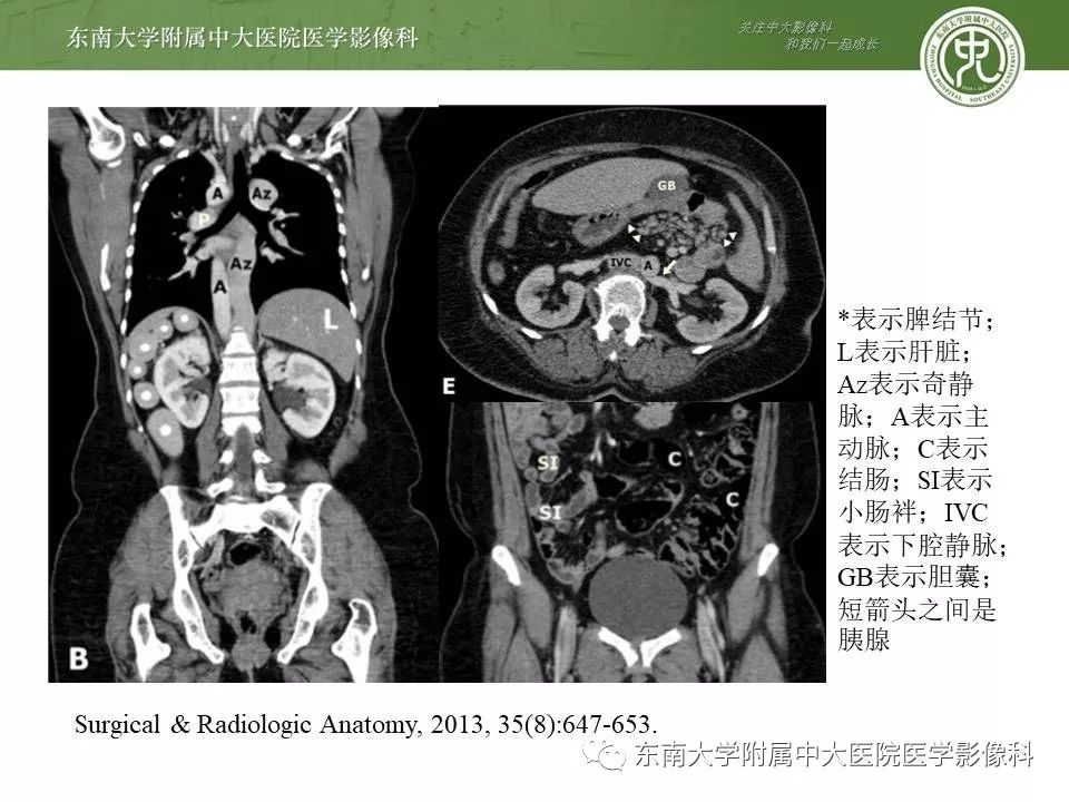 【PPT】多脾综合征的影像