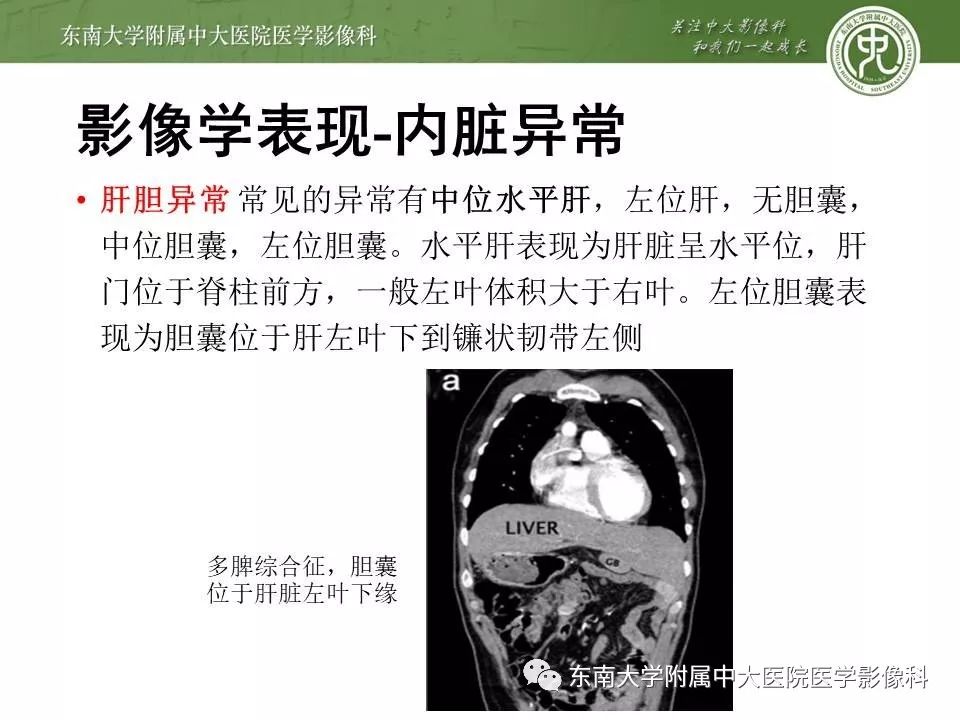 【PPT】多脾综合征的影像