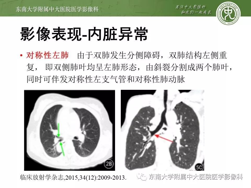 【PPT】多脾综合征的影像
