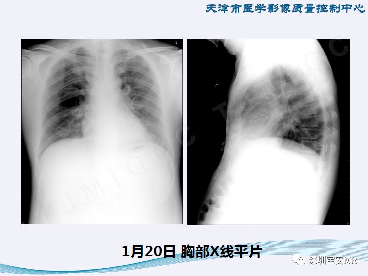 【PPT】新型冠状病毒感染肺炎影像学表现—阶段性总结