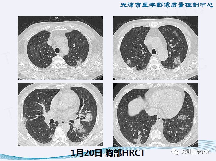 【PPT】新型冠状病毒感染肺炎影像学表现—阶段性总结
