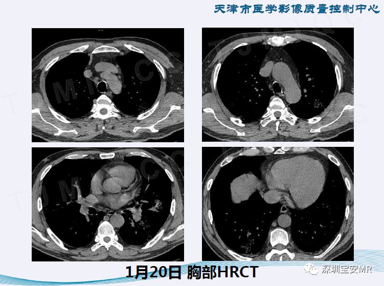 【PPT】新型冠状病毒感染肺炎影像学表现—阶段性总结
