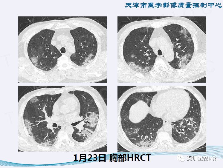 【PPT】新型冠状病毒感染肺炎影像学表现—阶段性总结