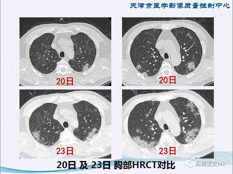 【PPT】新型冠状病毒感染肺炎影像学表现—阶段性总结