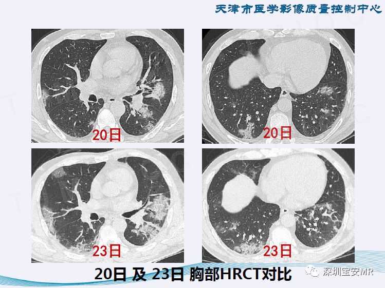 【PPT】新型冠状病毒感染肺炎影像学表现—阶段性总结