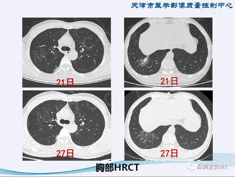 【PPT】新型冠状病毒感染肺炎影像学表现—阶段性总结