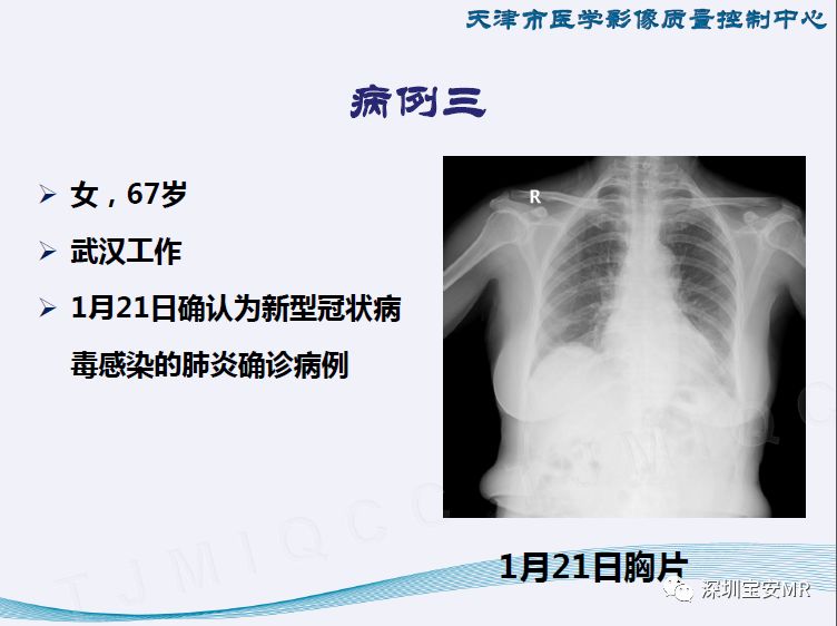 【PPT】新型冠状病毒感染肺炎影像学表现—阶段性总结