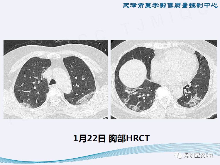 【PPT】新型冠状病毒感染肺炎影像学表现—阶段性总结
