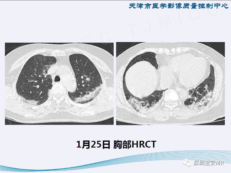 【PPT】新型冠状病毒感染肺炎影像学表现—阶段性总结