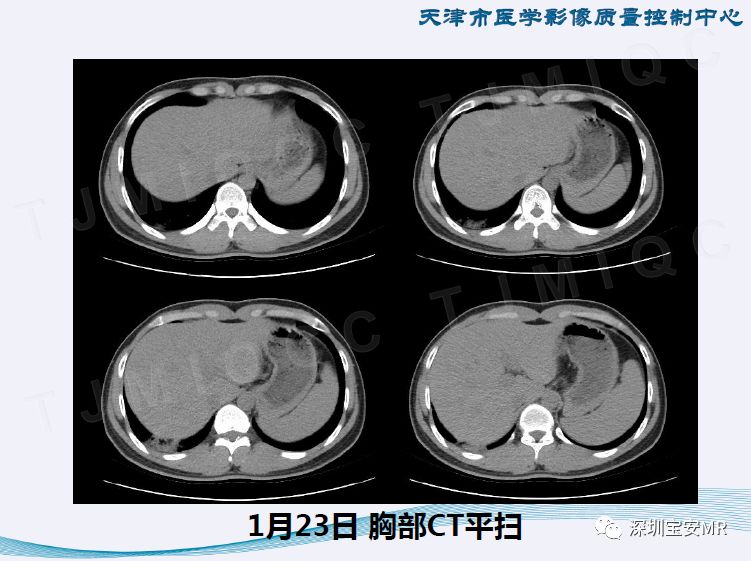 【PPT】新型冠状病毒感染肺炎影像学表现—阶段性总结