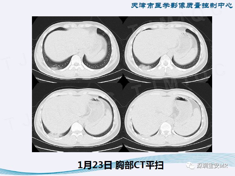 【PPT】新型冠状病毒感染肺炎影像学表现—阶段性总结