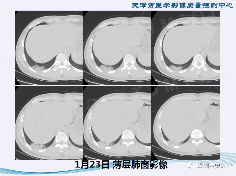 【PPT】新型冠状病毒感染肺炎影像学表现—阶段性总结