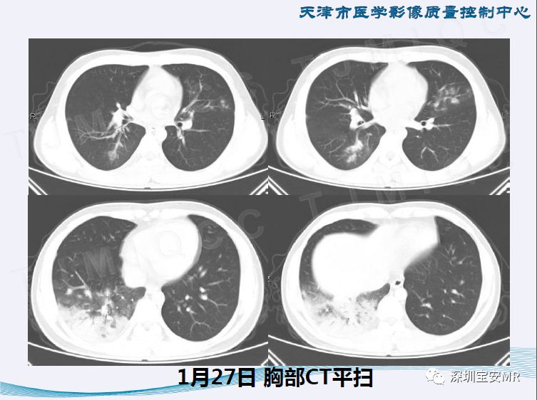 【PPT】新型冠状病毒感染肺炎影像学表现—阶段性总结