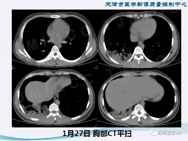 【PPT】新型冠状病毒感染肺炎影像学表现—阶段性总结