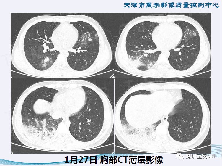 【PPT】新型冠状病毒感染肺炎影像学表现—阶段性总结