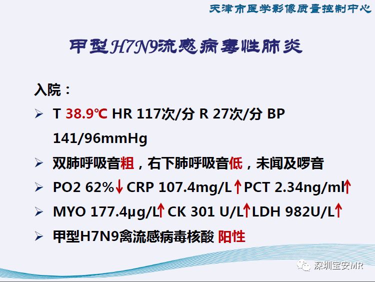 【PPT】新型冠状病毒感染肺炎影像学表现—阶段性总结