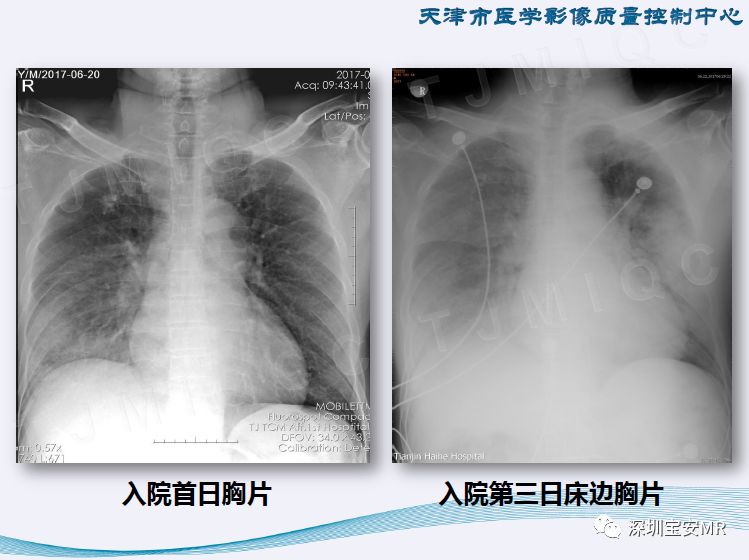 【PPT】新型冠状病毒感染肺炎影像学表现—阶段性总结
