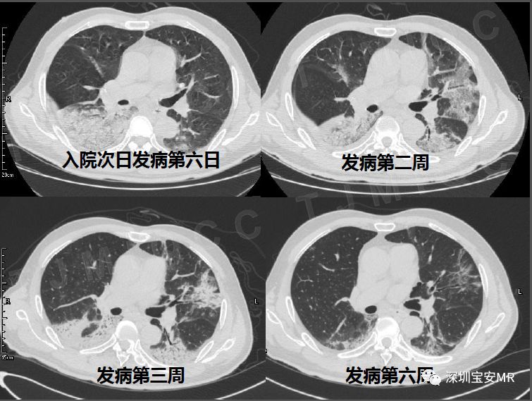 【PPT】新型冠状病毒感染肺炎影像学表现—阶段性总结