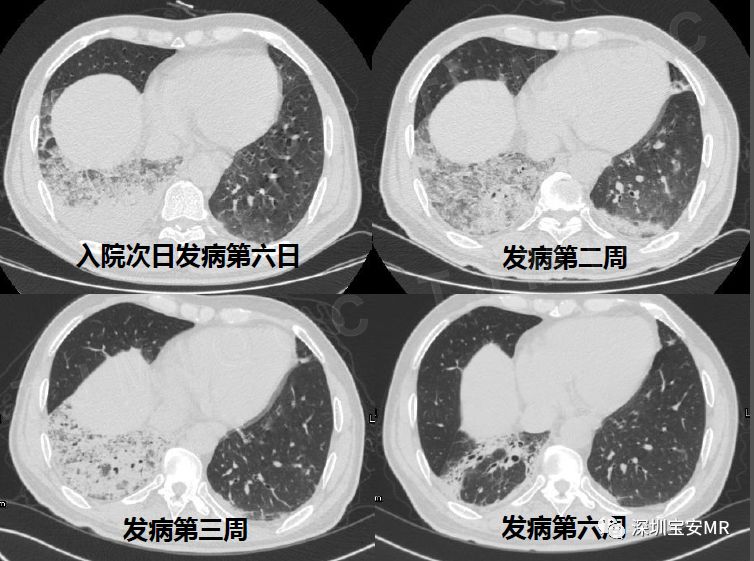【PPT】新型冠状病毒感染肺炎影像学表现—阶段性总结