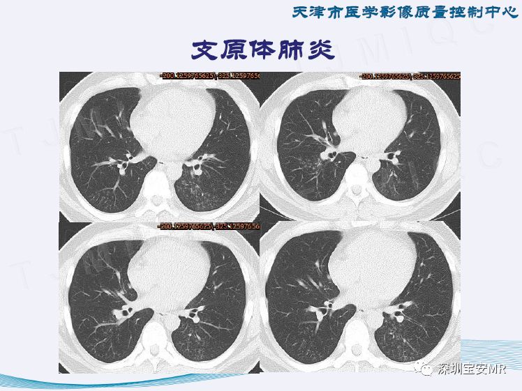 【PPT】新型冠状病毒感染肺炎影像学表现—阶段性总结