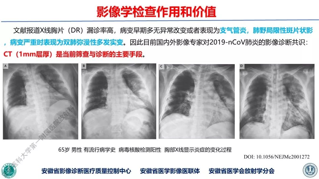 【PPT】新型冠状病毒肺炎影像学诊断