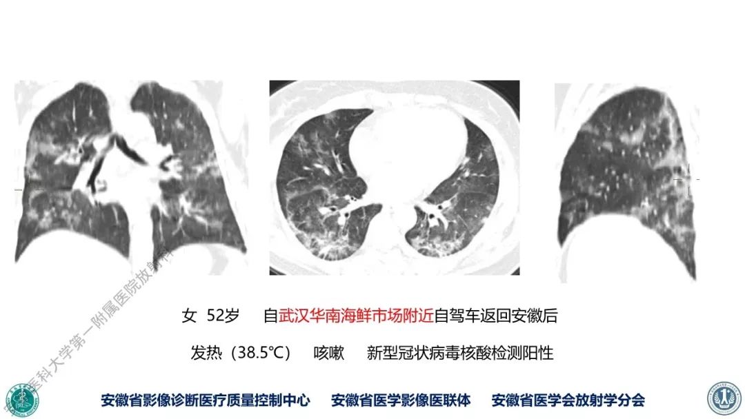 【PPT】新型冠状病毒肺炎影像学诊断
