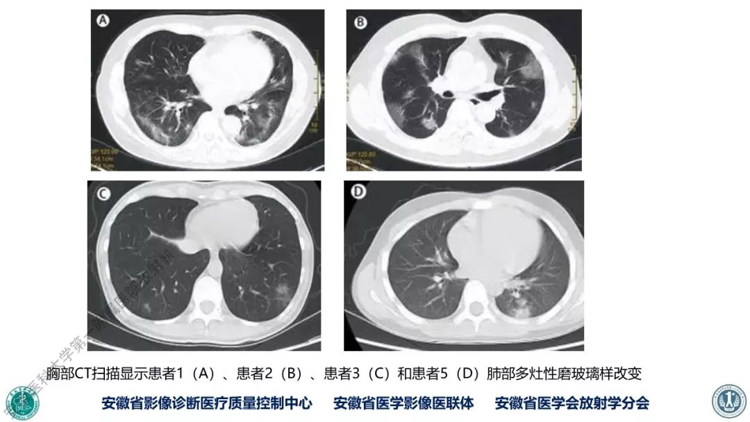 【PPT】新型冠状病毒肺炎影像学诊断