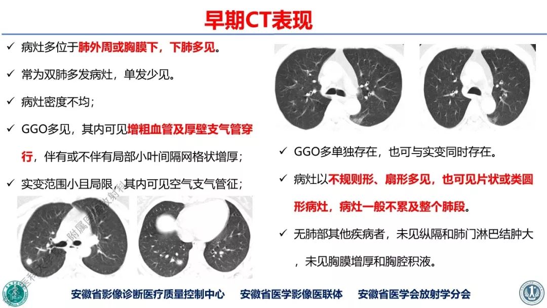 【PPT】新型冠状病毒肺炎影像学诊断