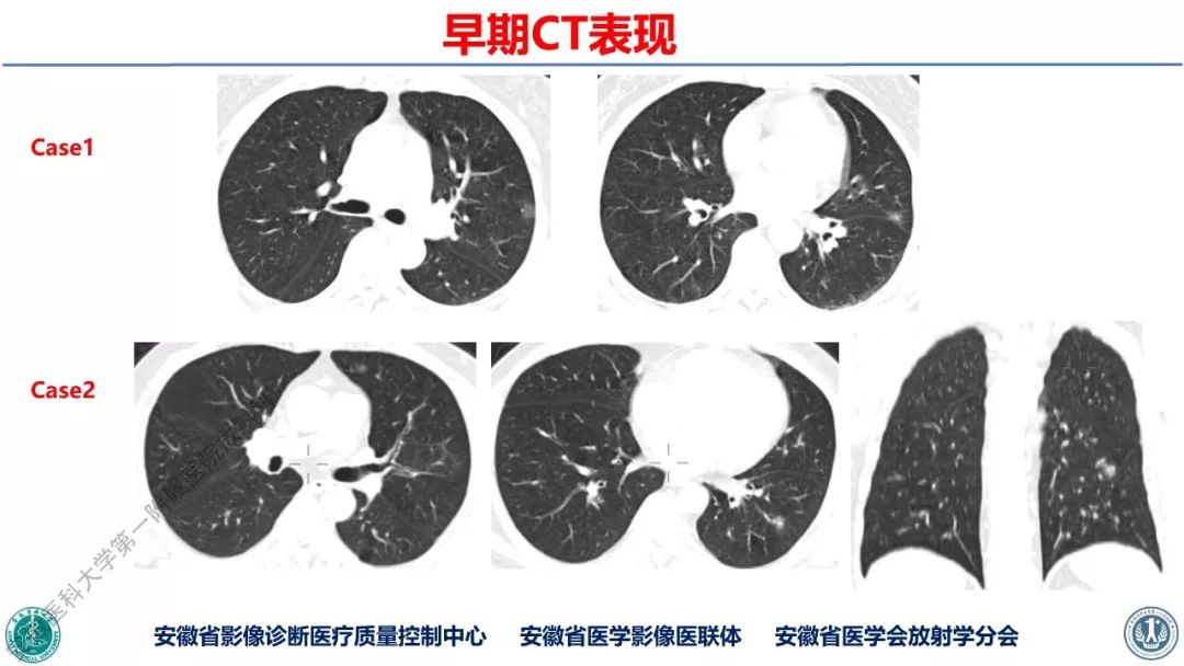 【PPT】新型冠状病毒肺炎影像学诊断
