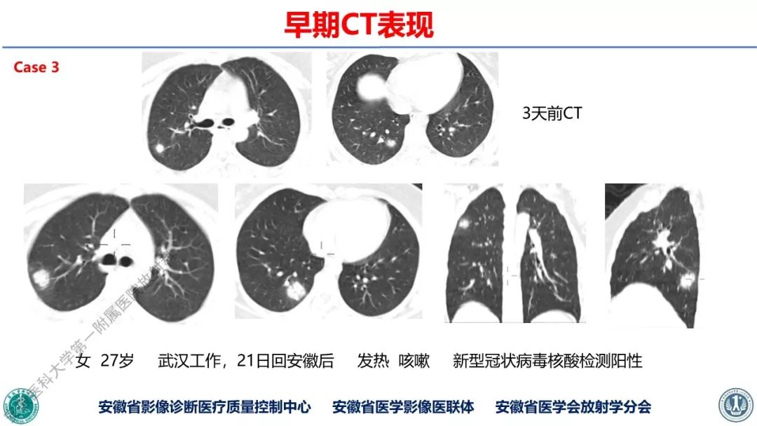 【PPT】新型冠状病毒肺炎影像学诊断