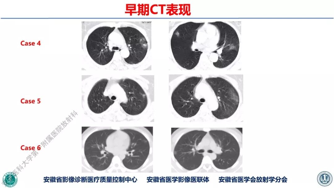 【PPT】新型冠状病毒肺炎影像学诊断