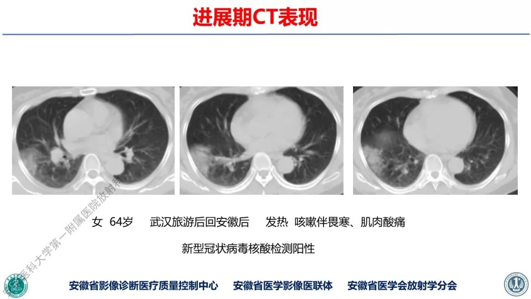 【PPT】新型冠状病毒肺炎影像学诊断