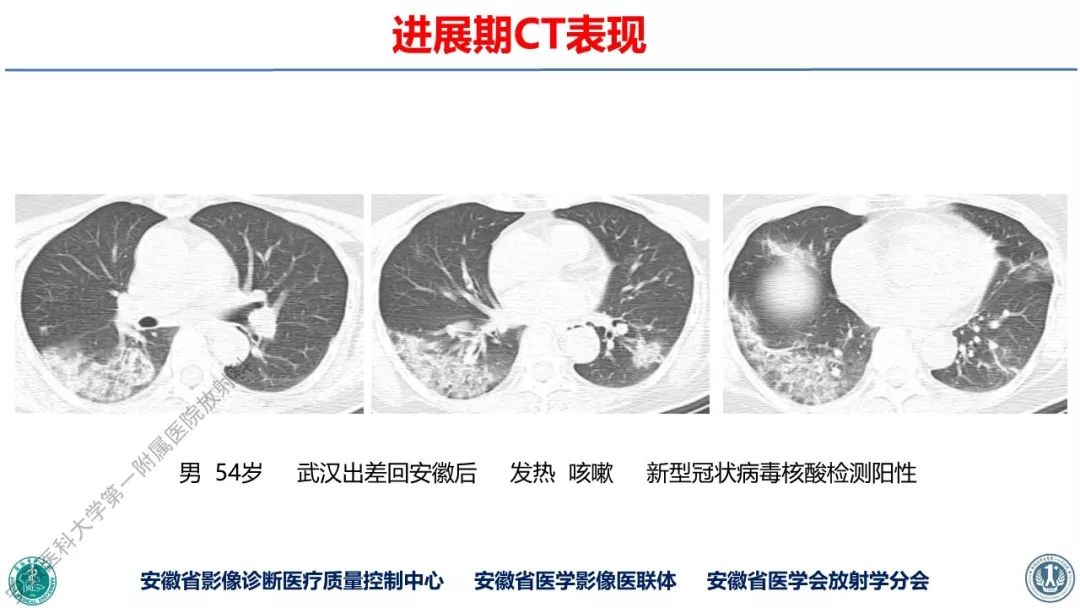 【PPT】新型冠状病毒肺炎影像学诊断