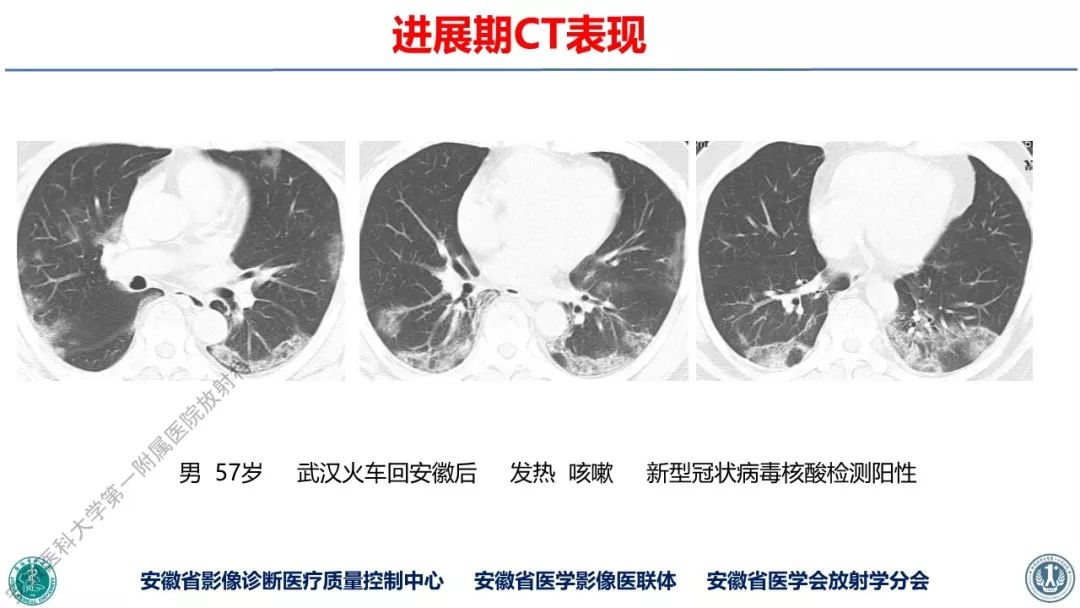 【PPT】新型冠状病毒肺炎影像学诊断