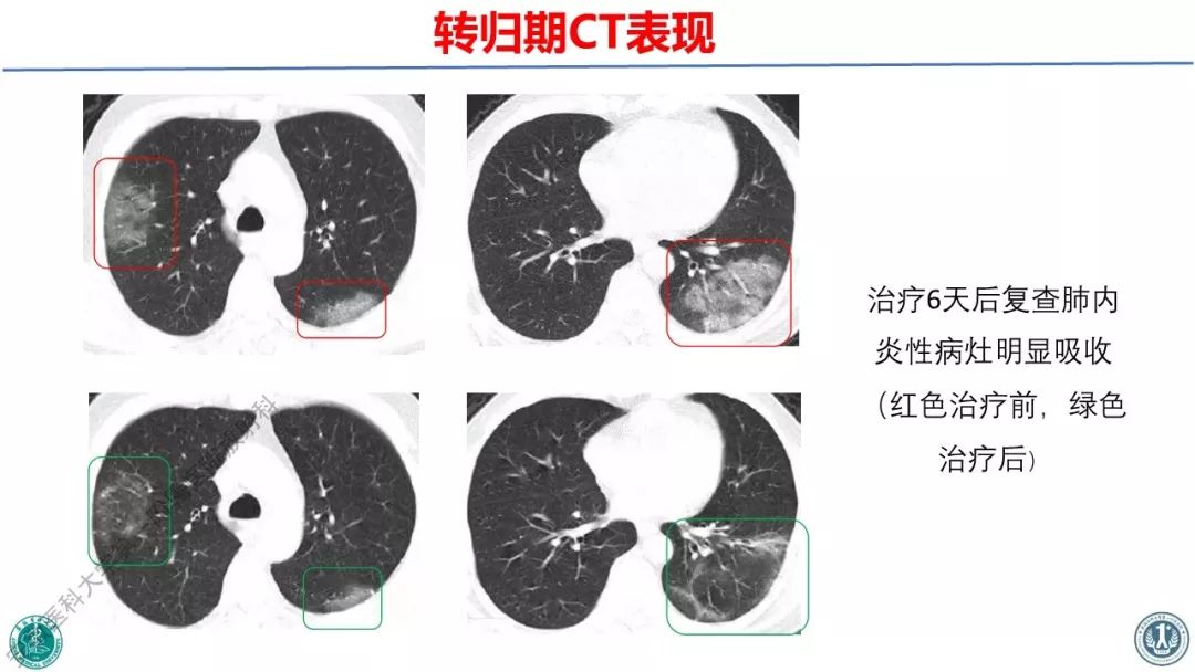 【PPT】新型冠状病毒肺炎影像学诊断