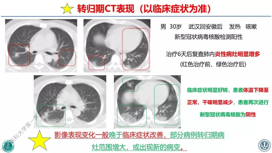 【PPT】新型冠状病毒肺炎影像学诊断