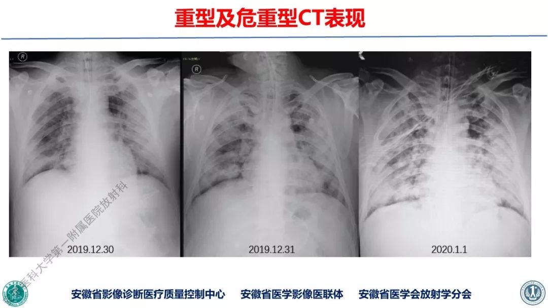 【PPT】新型冠状病毒肺炎影像学诊断