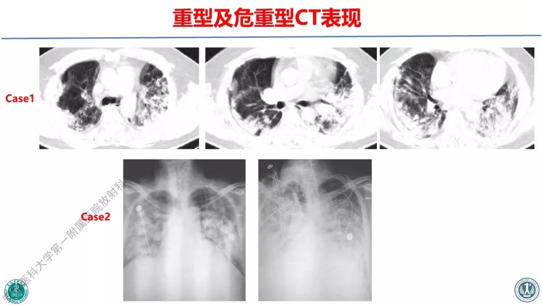 【PPT】新型冠状病毒肺炎影像学诊断