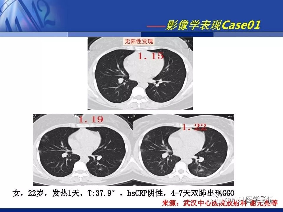 【PPT】新型冠状病毒肺炎的诊断与鉴别诊断