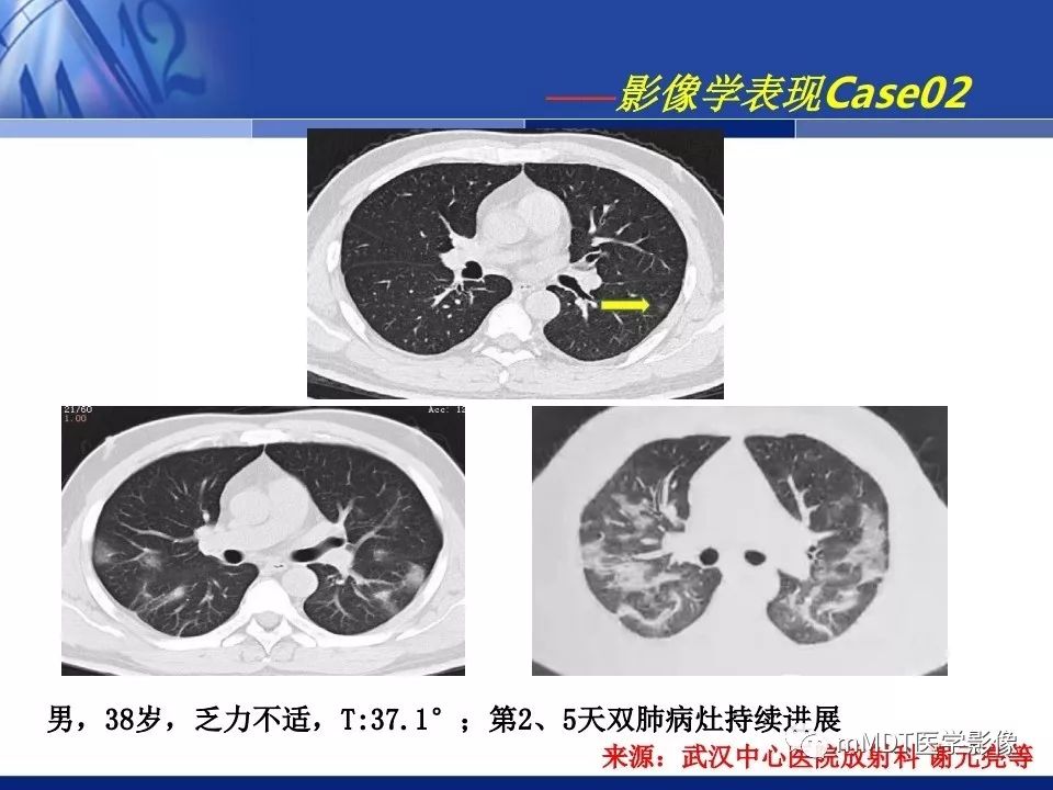 【PPT】新型冠状病毒肺炎的诊断与鉴别诊断