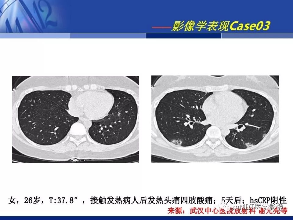 【PPT】新型冠状病毒肺炎的诊断与鉴别诊断