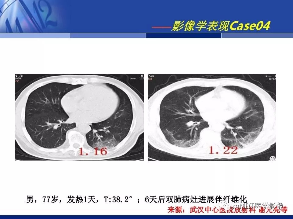 【PPT】新型冠状病毒肺炎的诊断与鉴别诊断